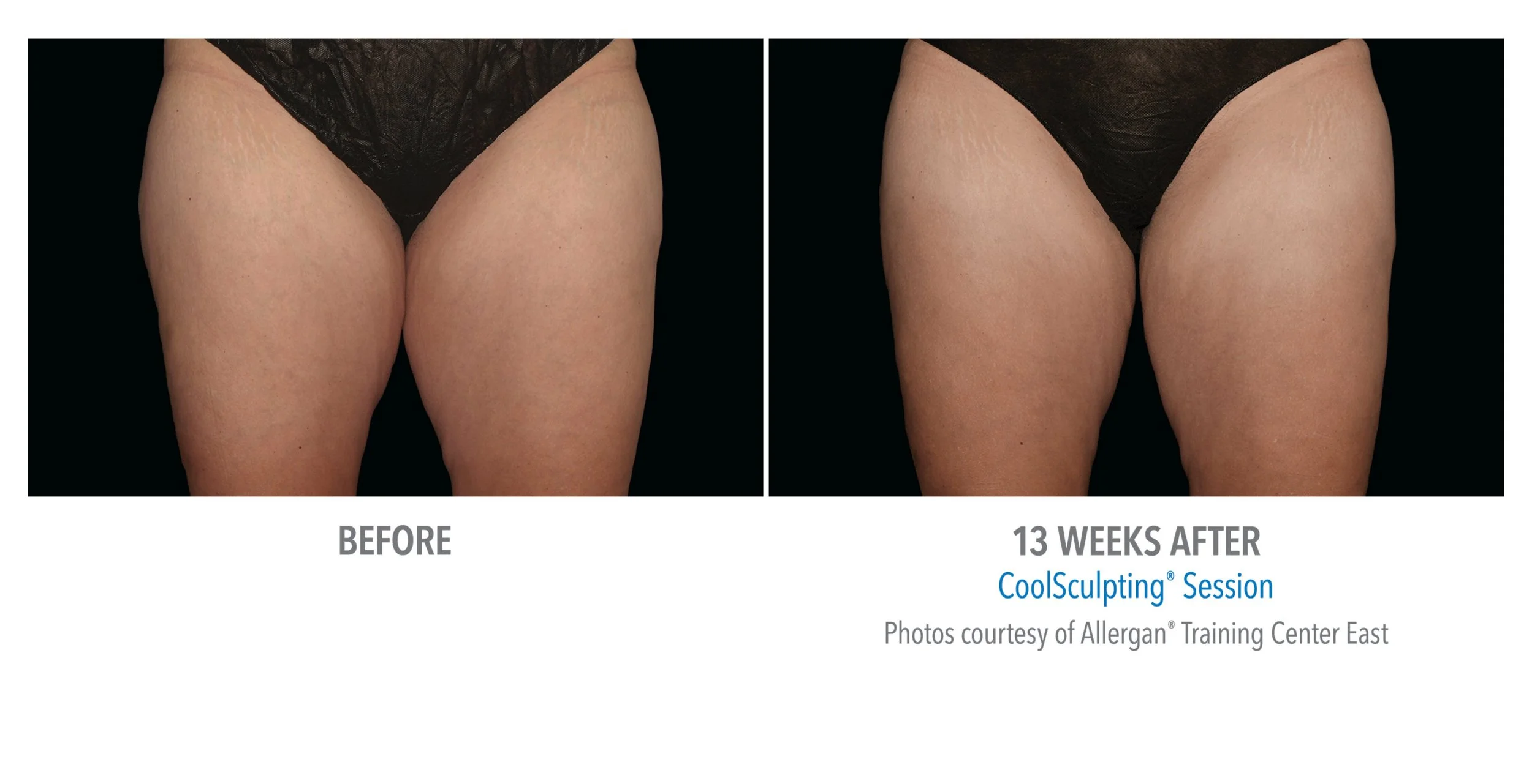 Side-by-side comparison of women's thighs before and 13 weeks after a CoolSculpting session, showing a reduction in fat. The 'Before' image depicts larger thighs, while the '13 Weeks After' image shows thinner thighs with less fat.