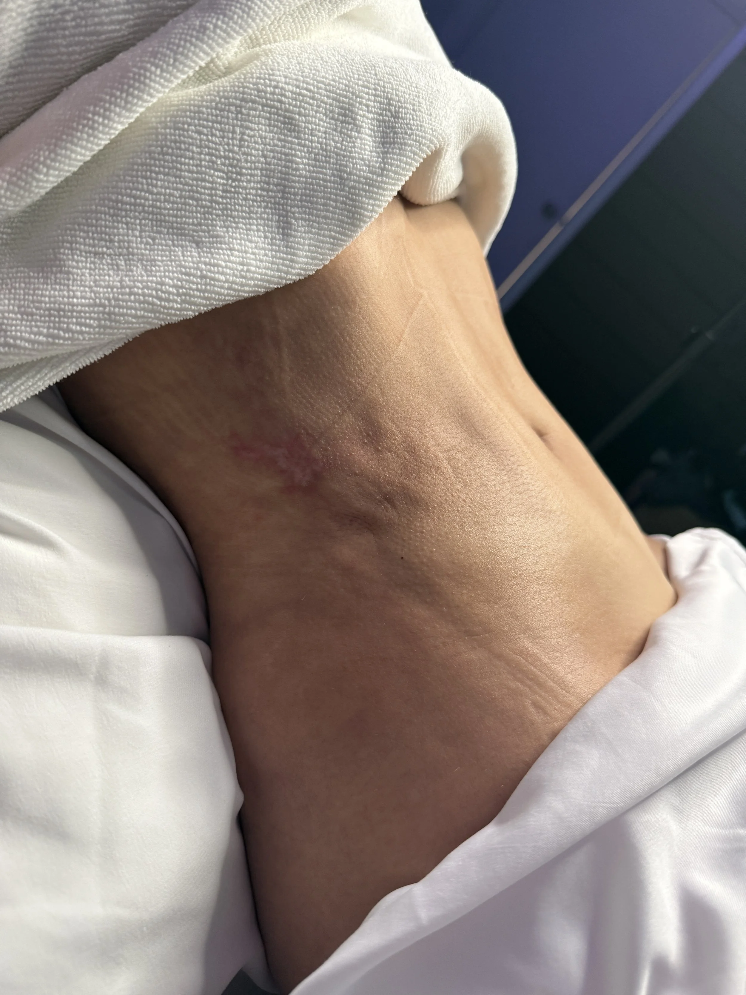 Sculpt Fairy Post op after lipo