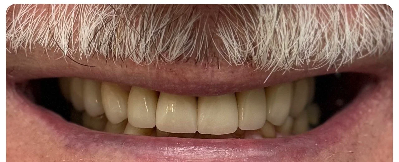 full mouth rehabilitation after treatment second example