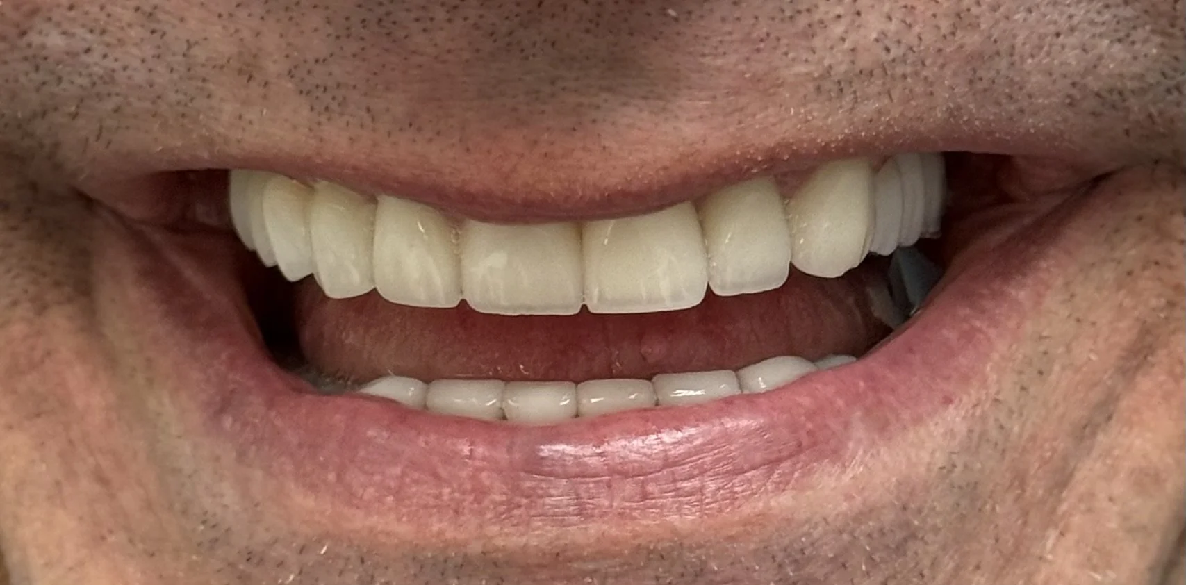 full mouth rehabilitation treatment by dentist in madison nj