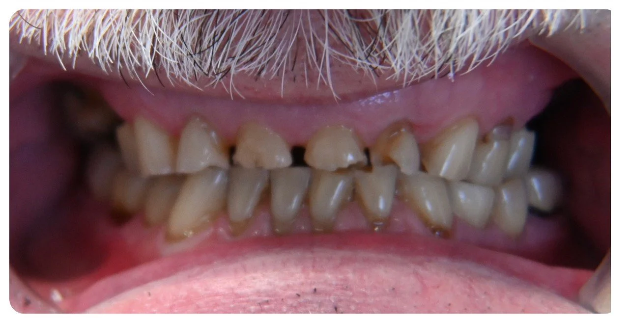 full mouth rehabilitation before treatment second example