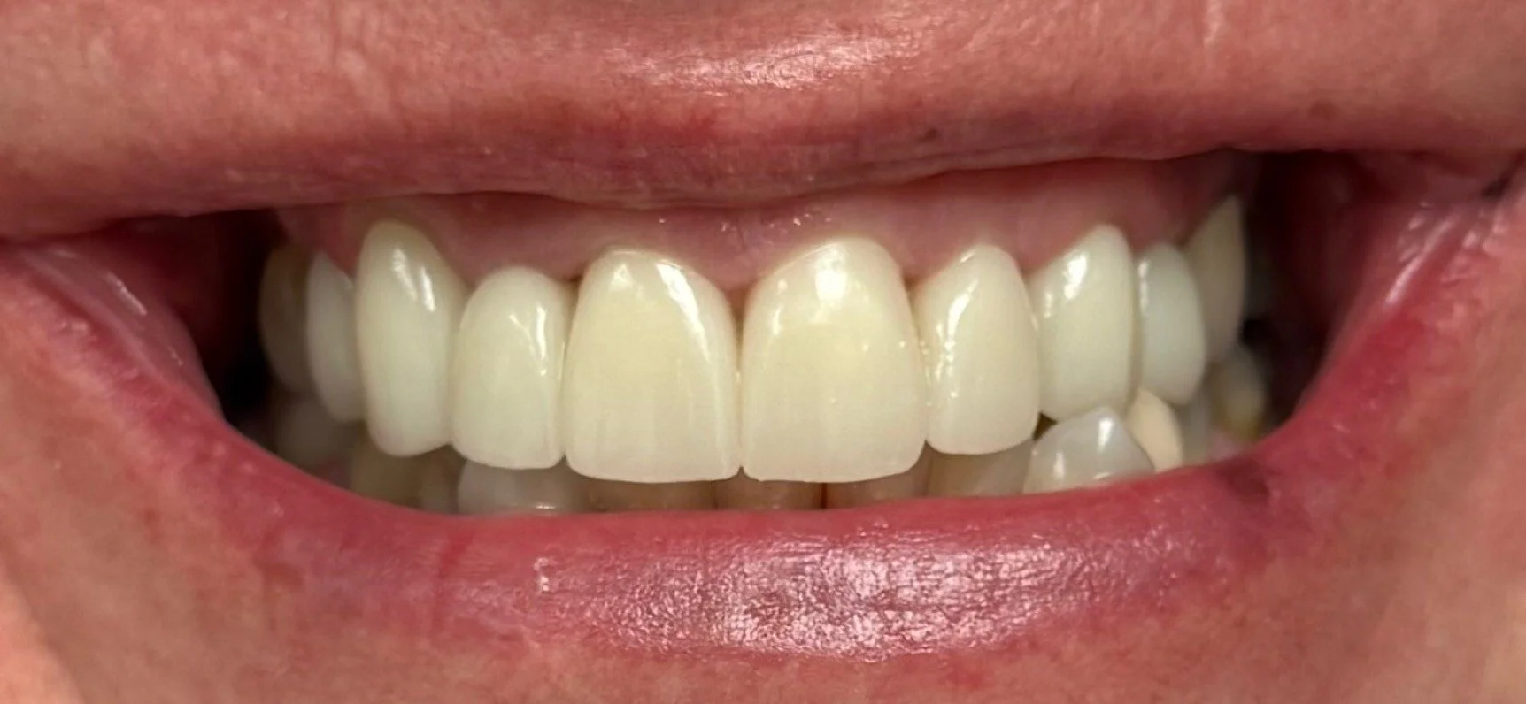 dental crowns after treatment
