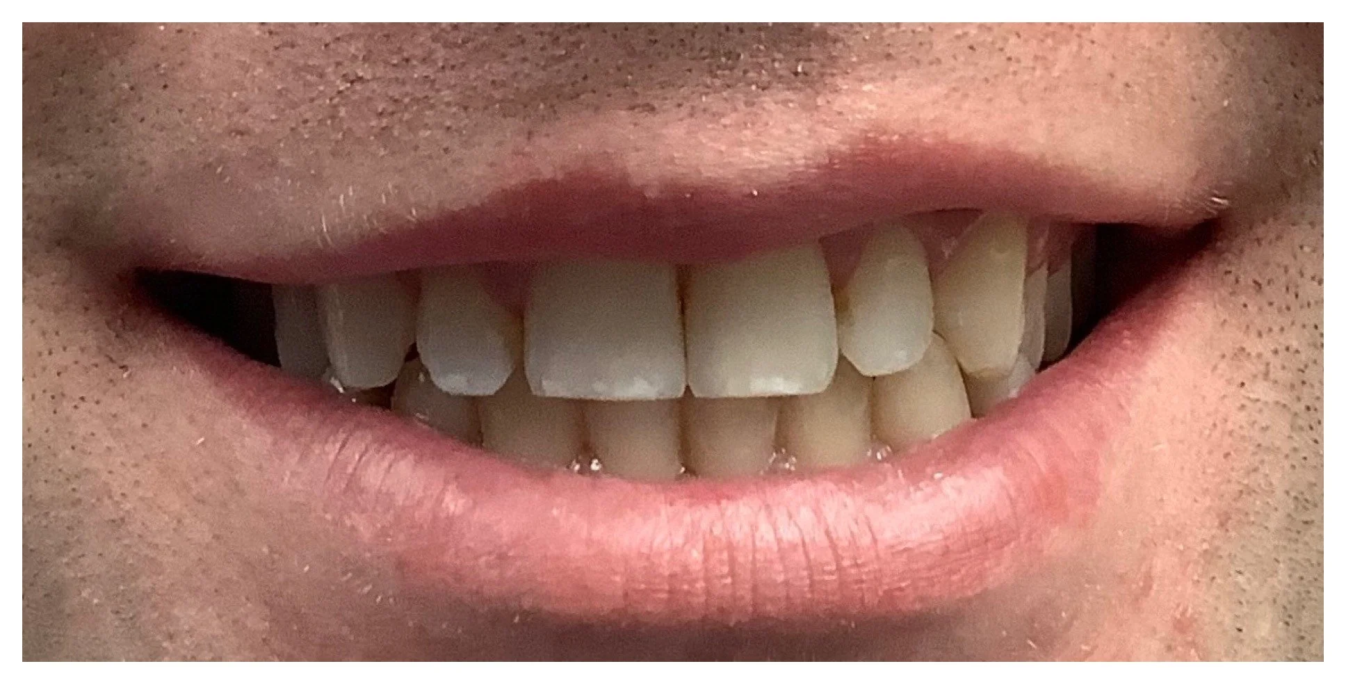 peg laterals dental before treatment from dentist in florham park, nj