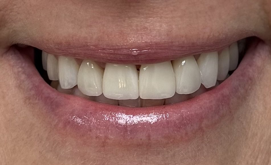 Dental veneers after treatment / dentist in florham park, nj