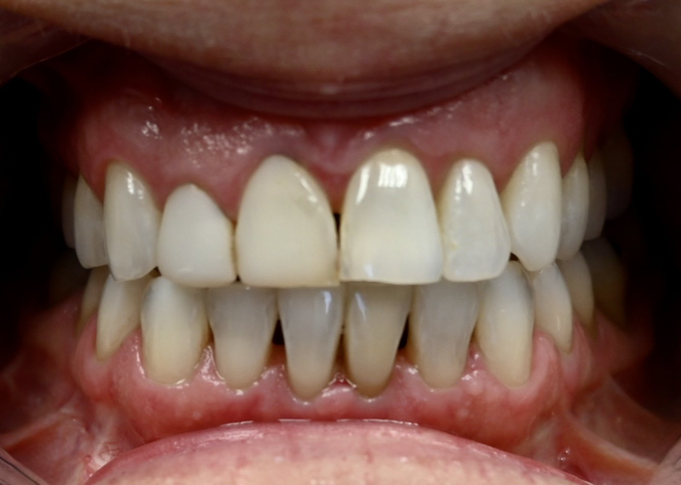 Dental veneers before treatment
