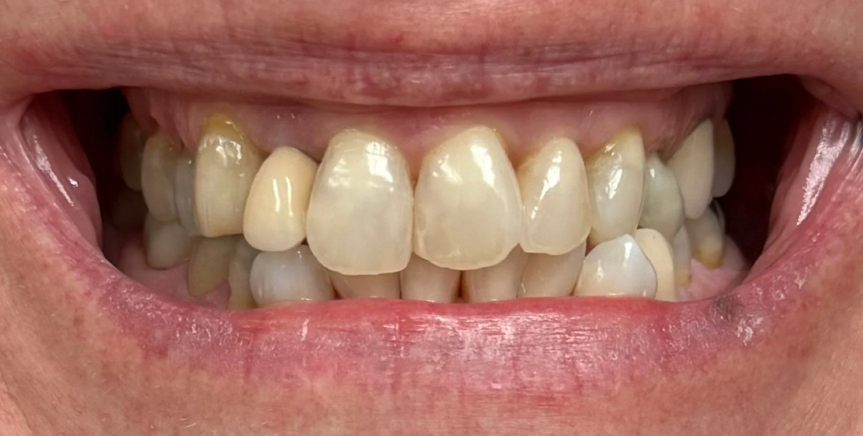 dental crowns before treatment