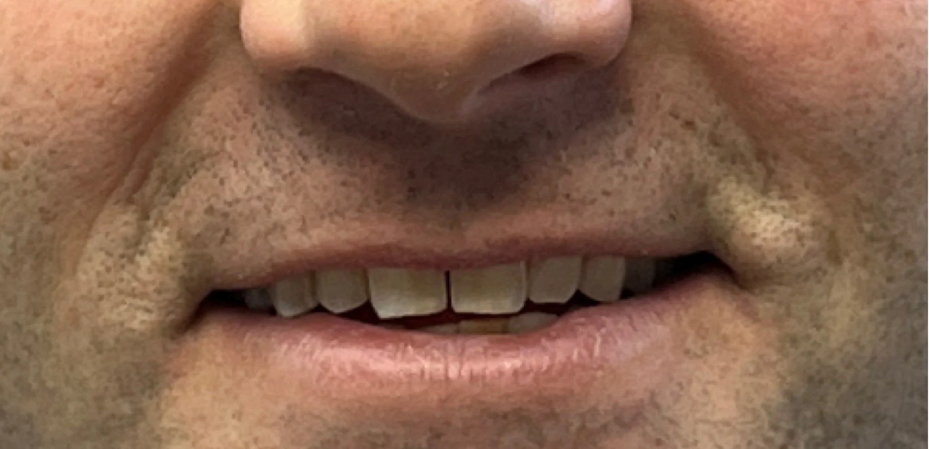 Invisalign and reshaping before treatment