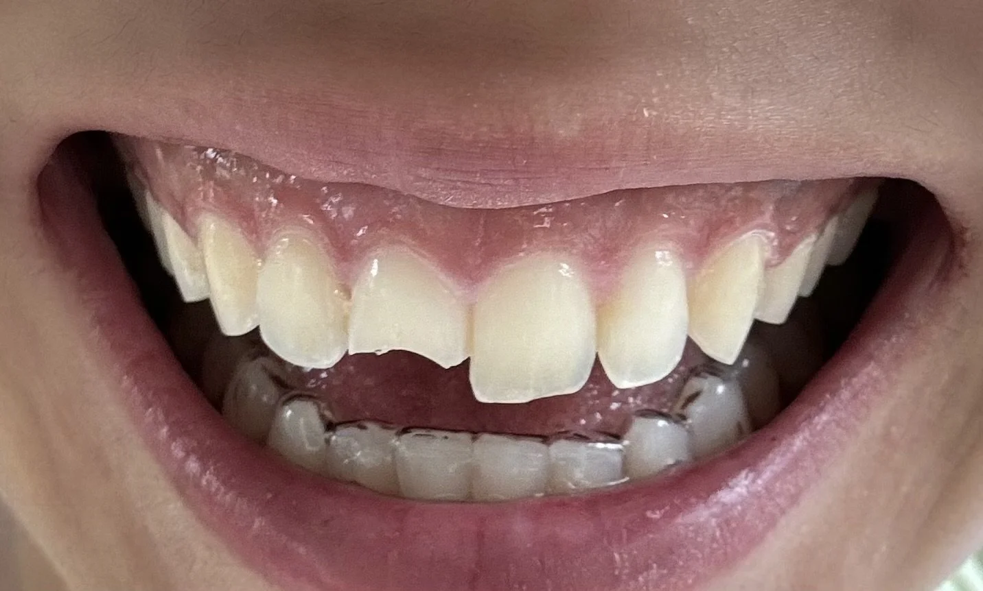 cracked tooth before treatment