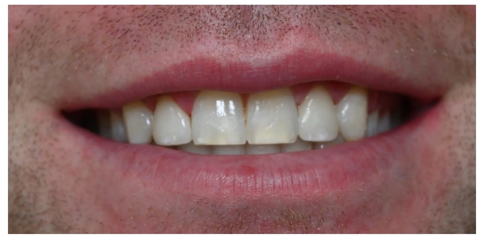 peg laterals dental after treatment