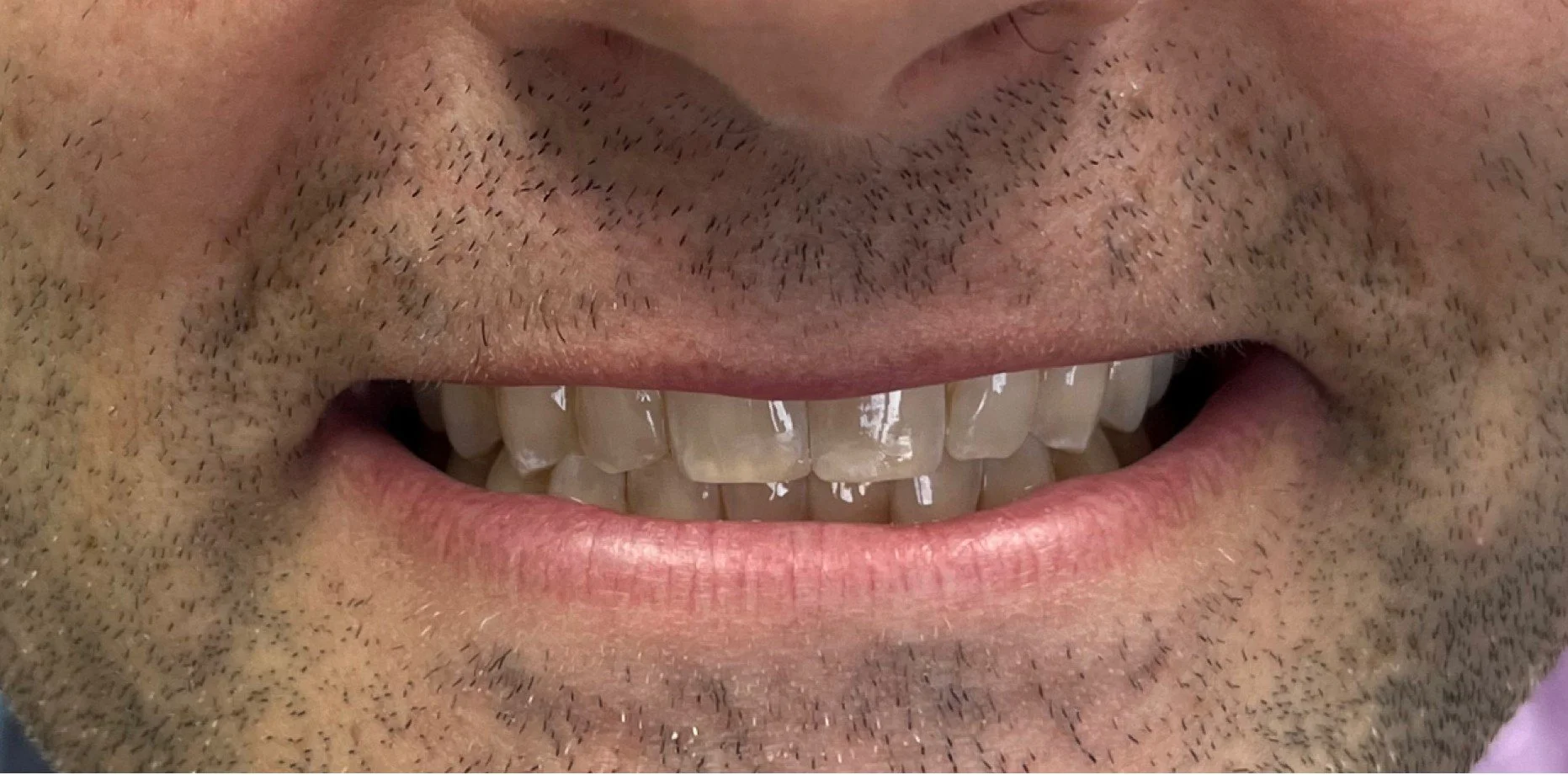Invisalign and reshaping after treatment