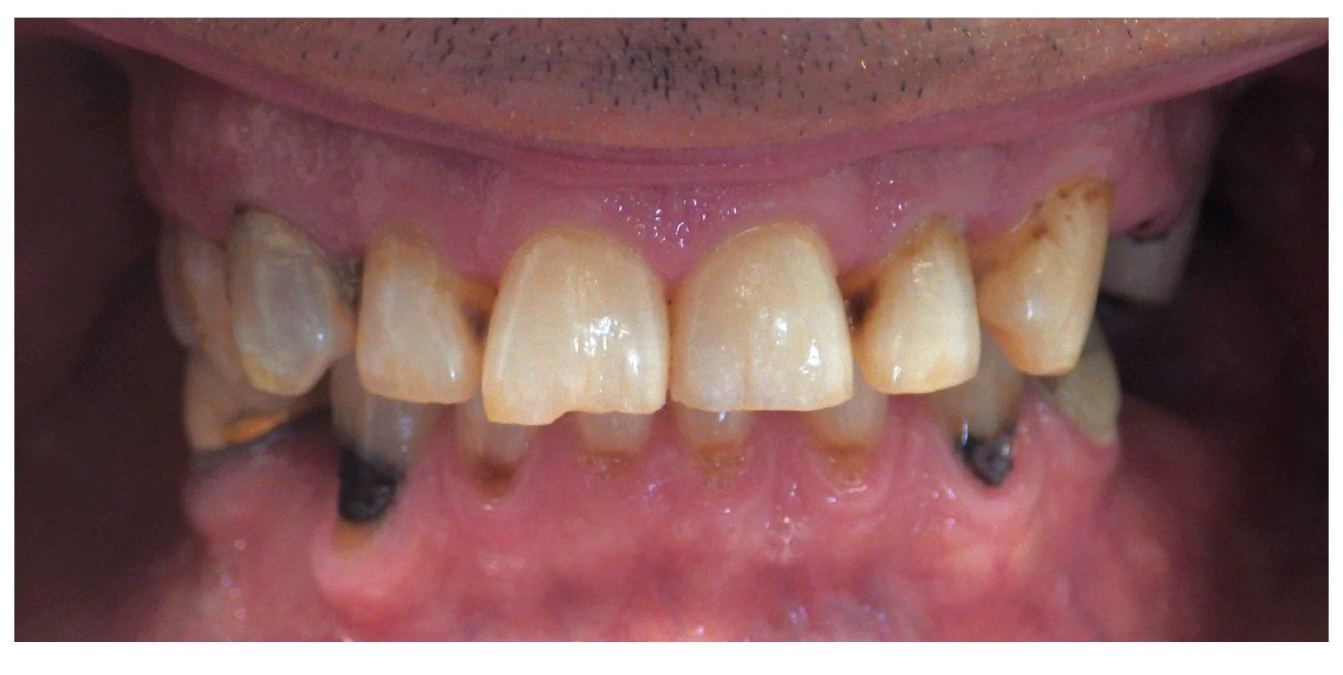 full mouth rehabilitation before treatment