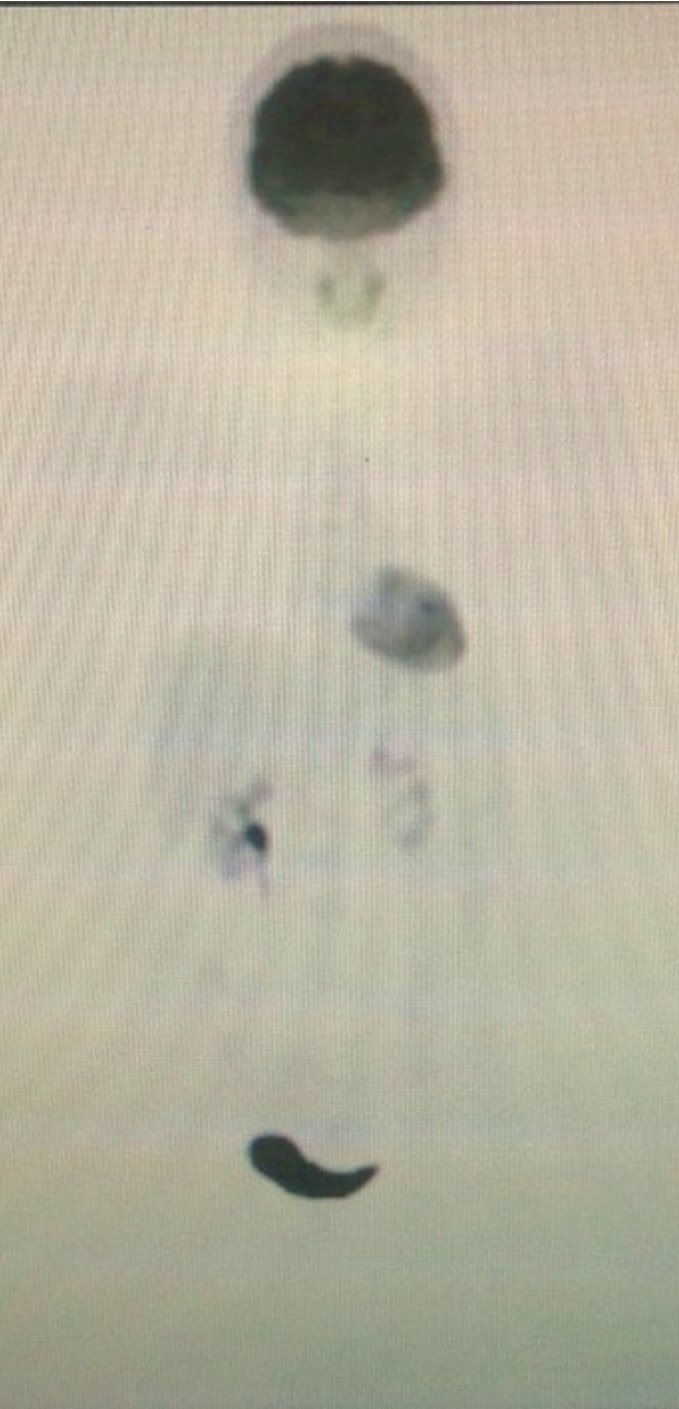 CURRENT P.E.T. (CANCER) SCAN JUNE/10.