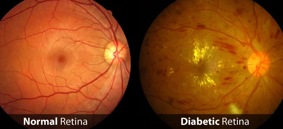 Protecting Your Vision: What You Need to Know About Diabetic Retinopathy