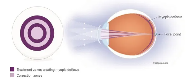 Clinical diagram of CooperVision MiSight 1-day contact lenses, demonstrating how the dual-focus design uses concentric treatment zones to create peripheral myopic defocus on the retina while maintaining a clear central focal point to manage childhood