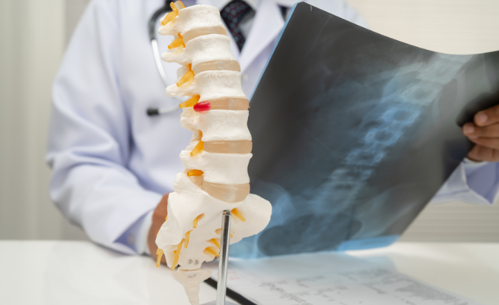 Case Study: Closing a $518K Revenue Gap in Spine Surgery Billing
