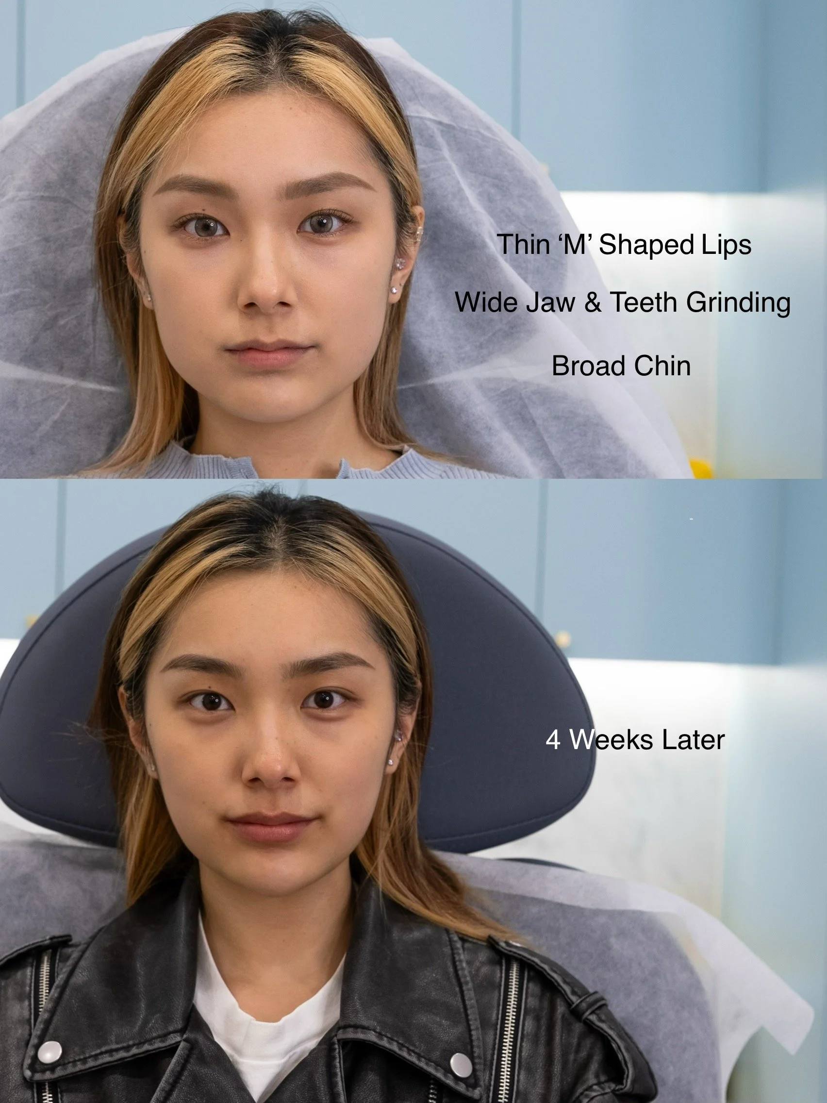 3.Lips Chin Masseters.jpg