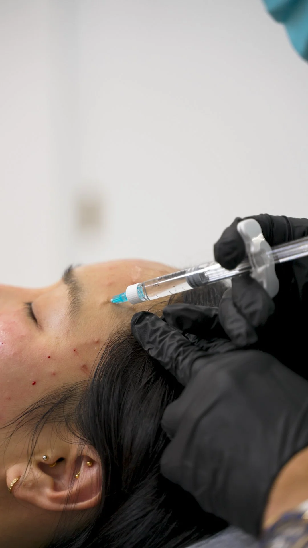Can Rejuran Treat Acne Scars, Hyperpigmentation, or Texture?