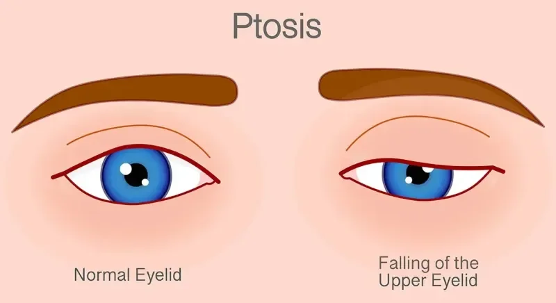 ptosis.webp