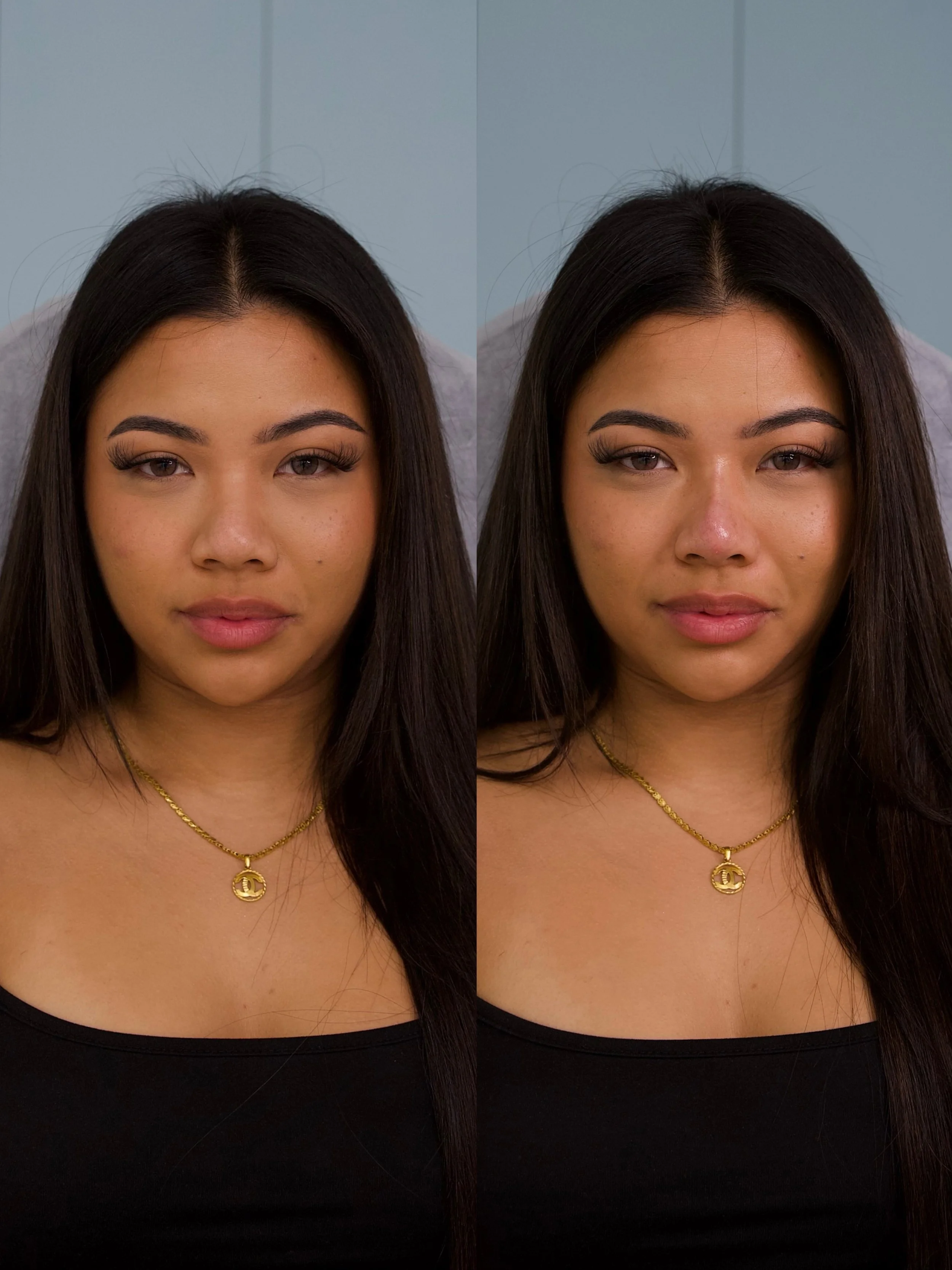 Can a Non-Surgical Nose Job Make Your Nose Smaller?