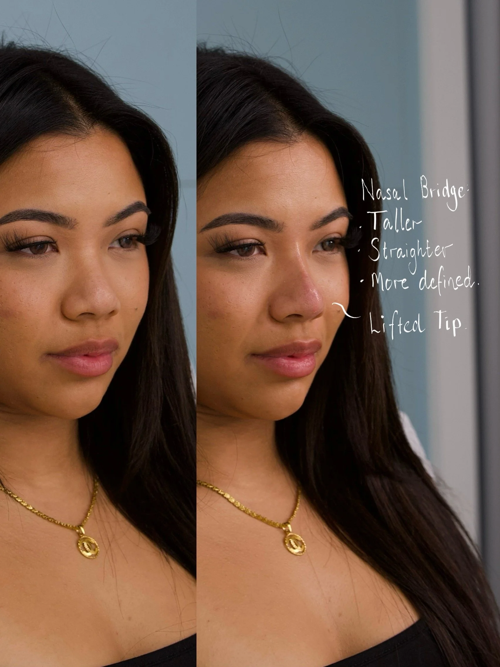 Can You Get a Non-Surgical Nose Job After Rhinoplasty Surgery?