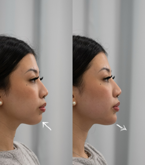 What Is a Weak Chin and How Does It Affect Your Face?