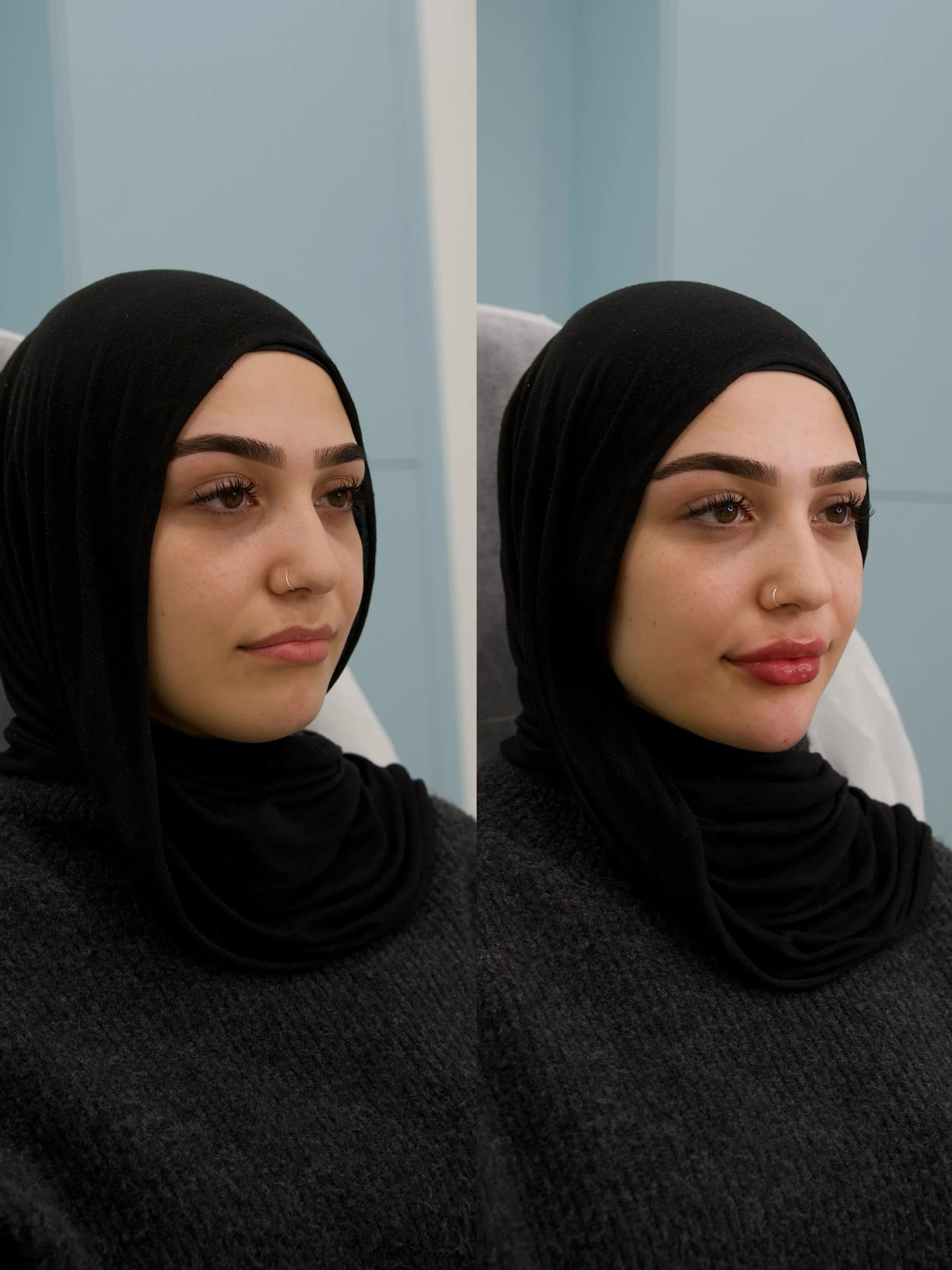 First-Time Lip Enhancement: What to Expect Before, During, and After