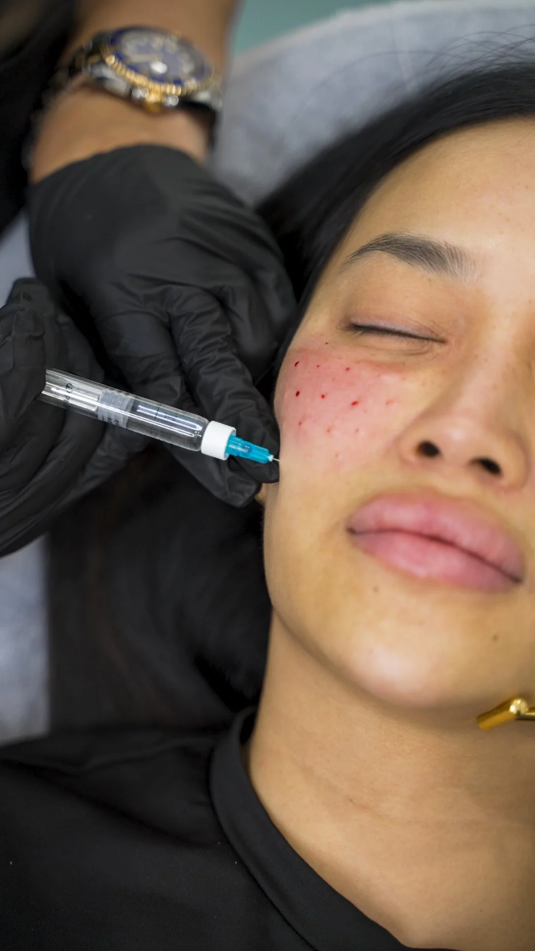 rejuran procedure-66.jpg