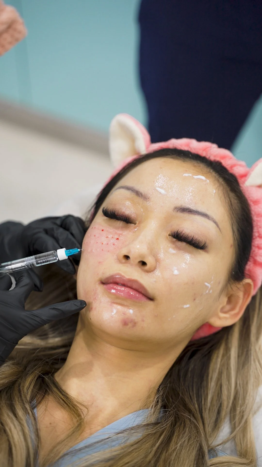 rejuran procedure-50.jpg