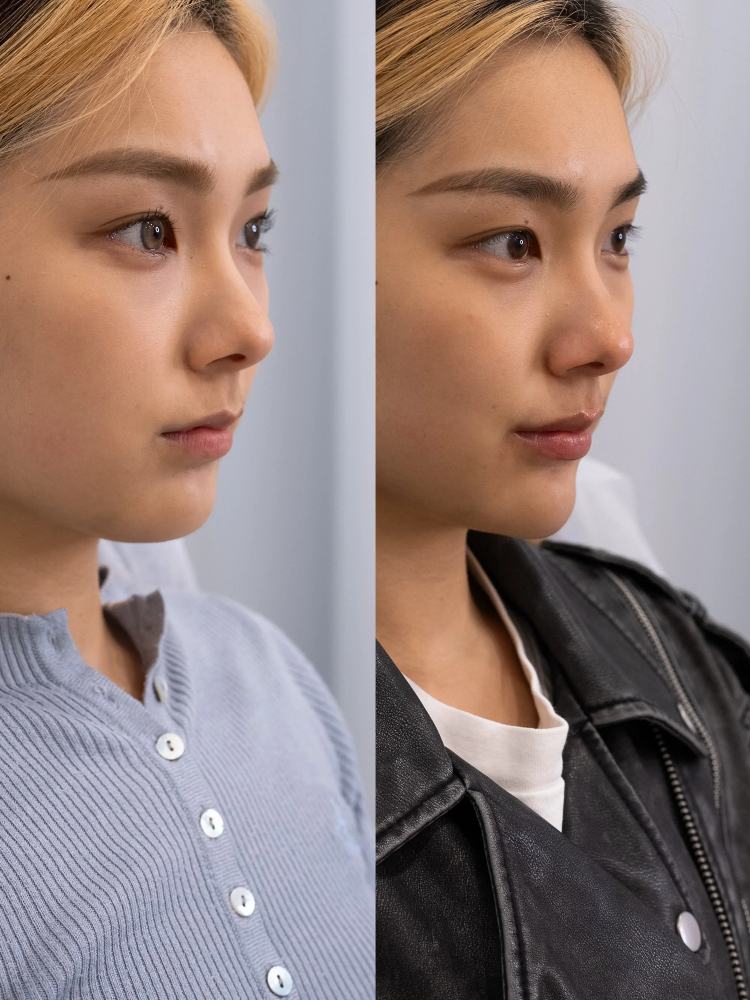 6.Lips Chin Masseters.jpeg