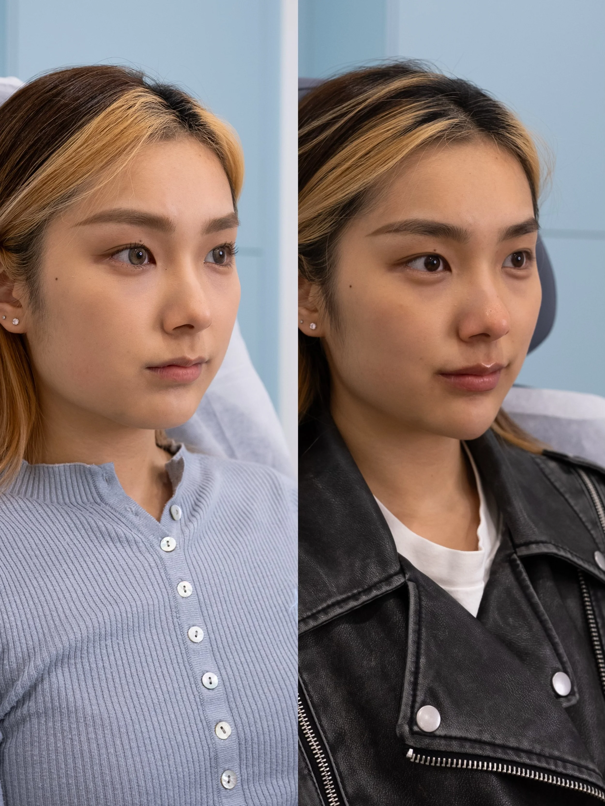 5.Lips Chin Masseters.jpeg