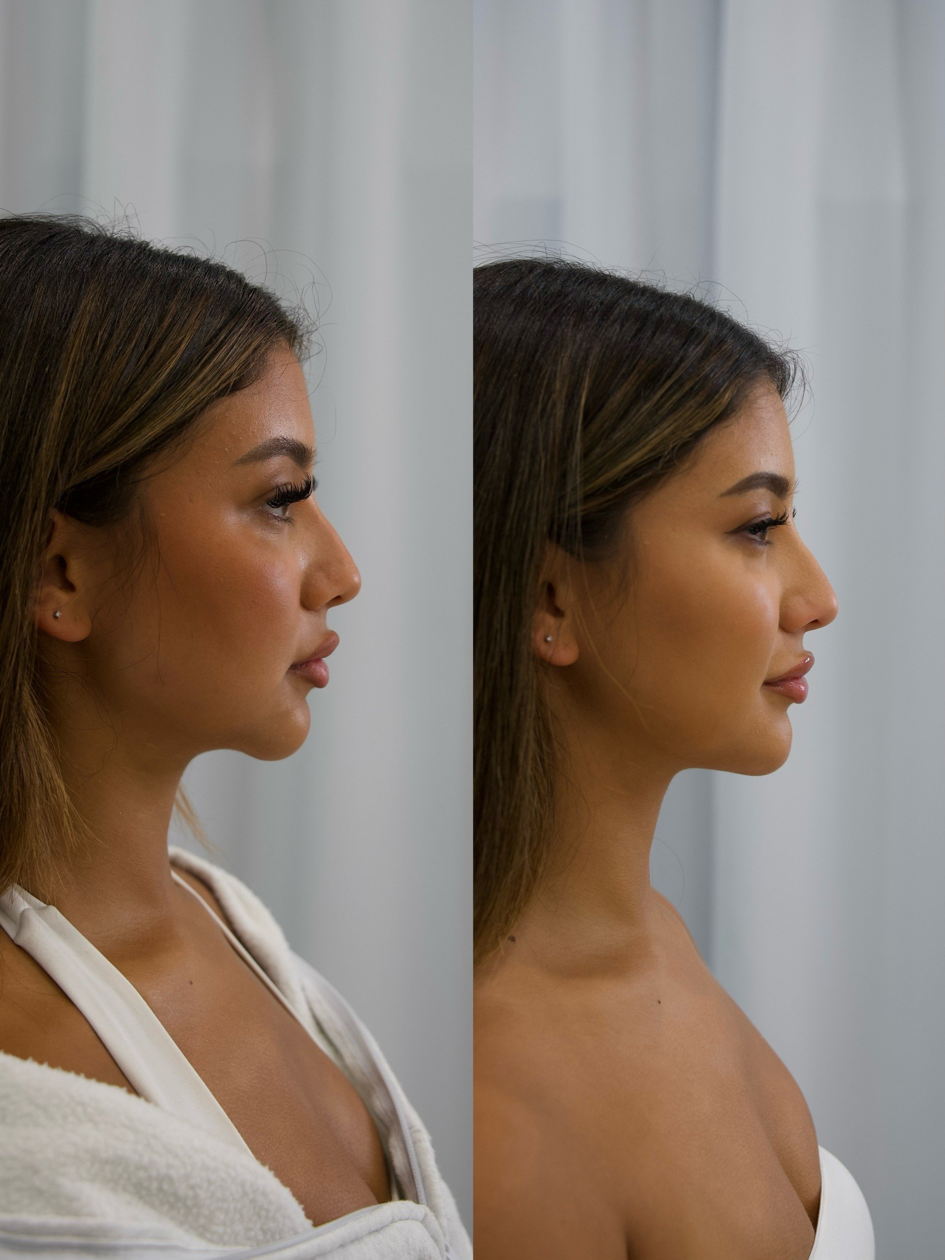 Masseters Female Botox Melbourne 4