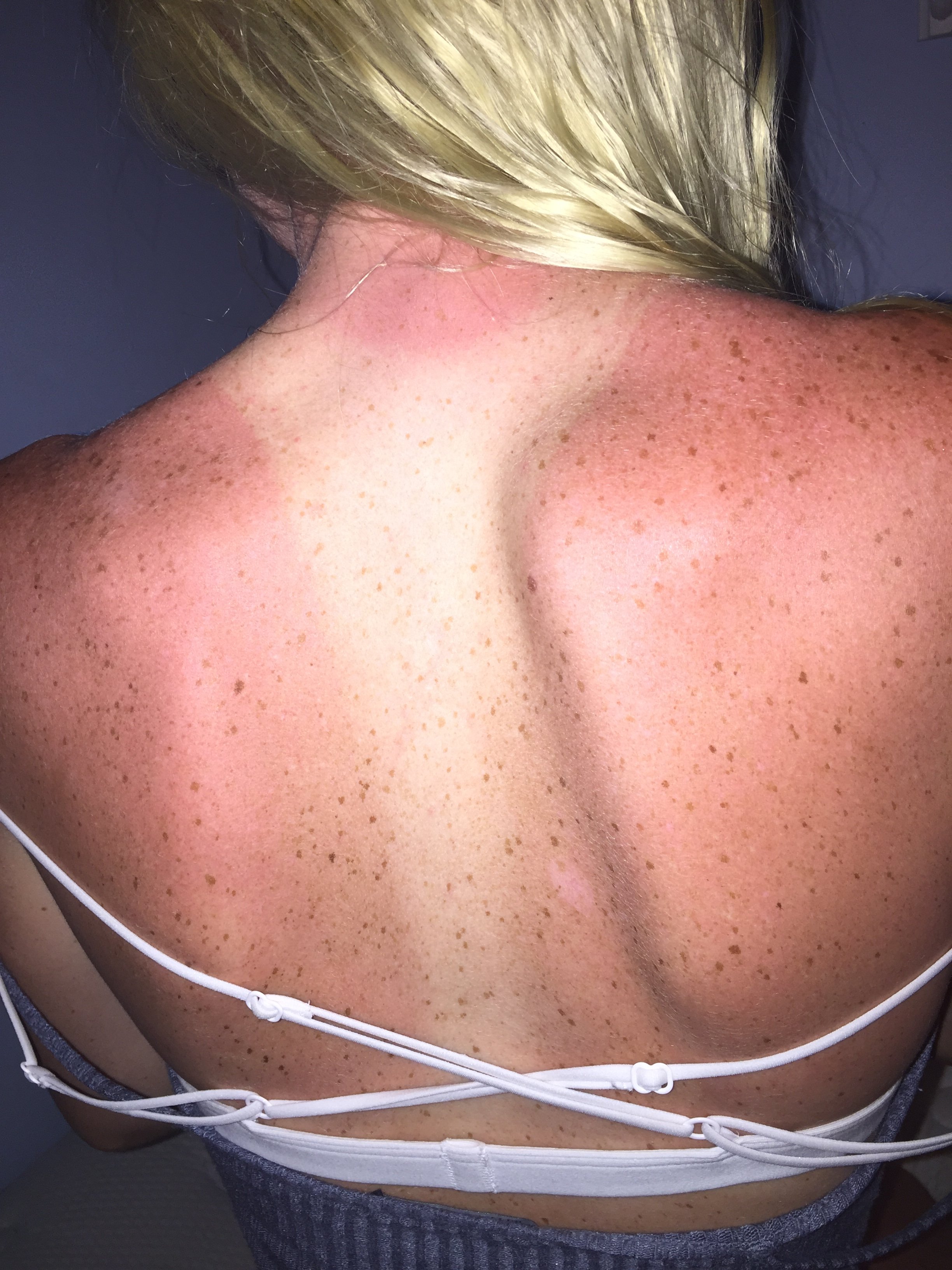 my 14 y/o sunburnt back