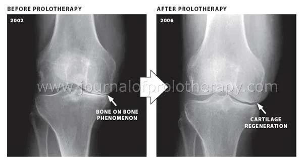 Comparison of knee X-rays showing bone on bone phenomenon in 2002 before prolotheapy and cartilage regeneration in 2006 after prolotheapy.