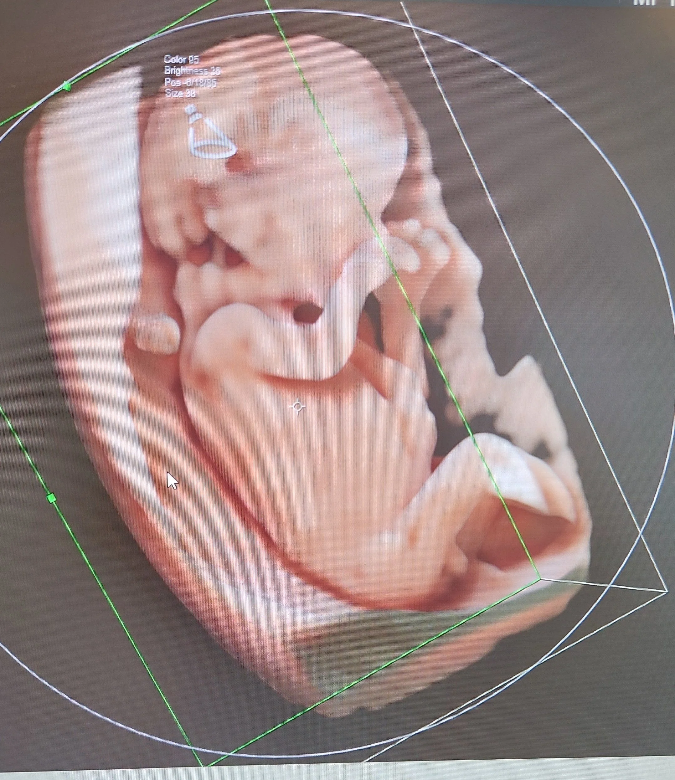 Image d'un modèle 3D d'un fœtus humain dans l'utérus, en cours de développement. La modélisation est entourée de lignes de guidage en vert et blanc. Cabinet Medical Naissance: