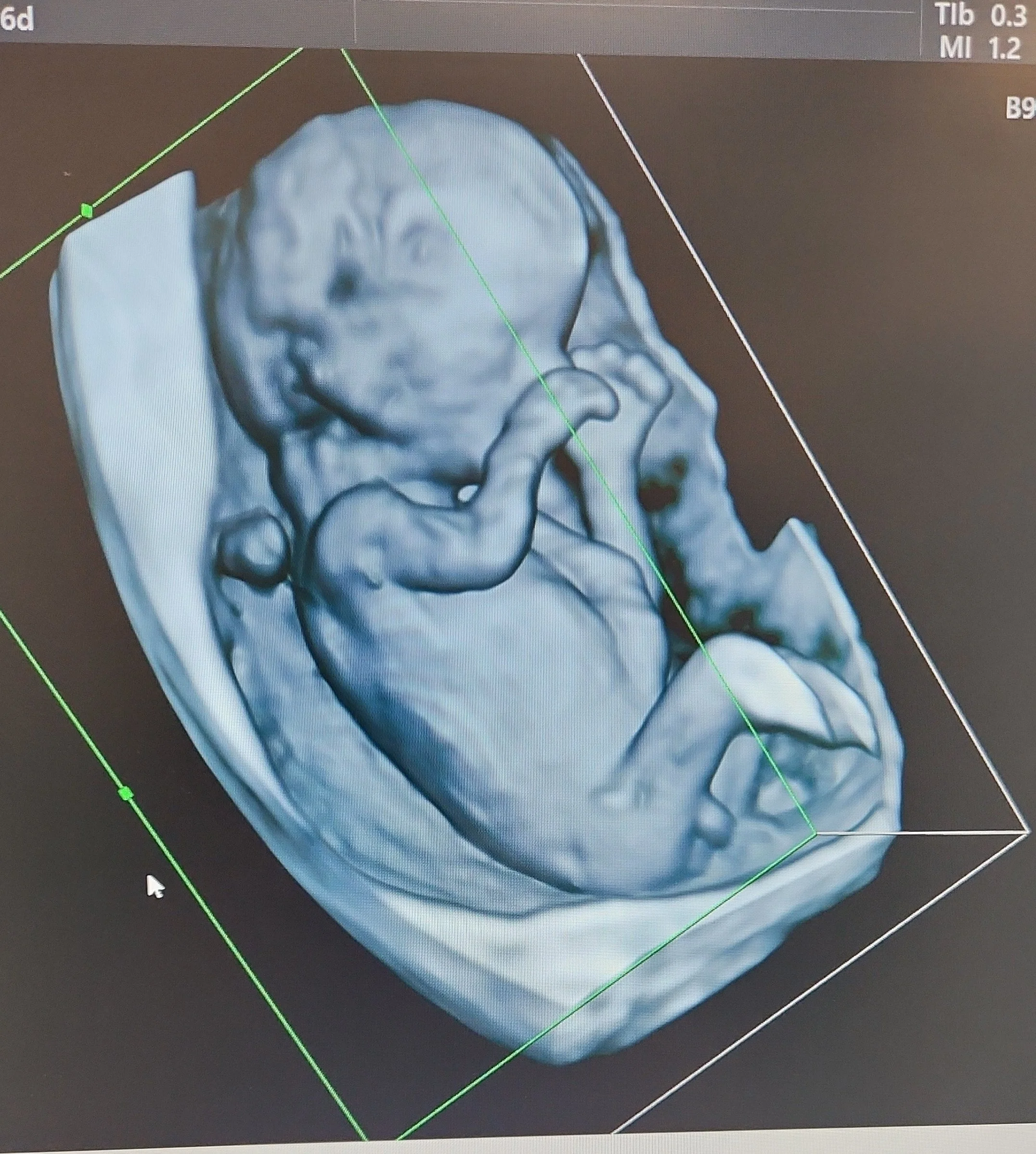 Image d'une échographie 3D montrant un fœtus humain dans l'utérus.