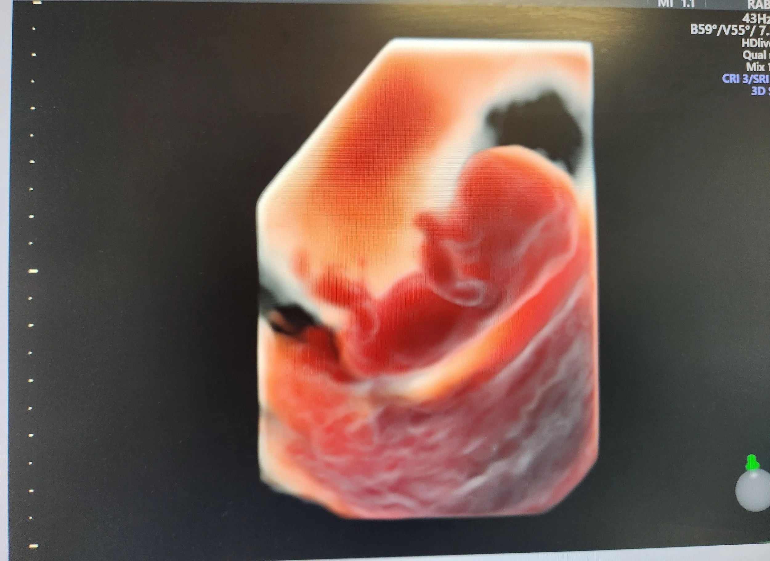 Illustration d'une échographie 3D d'un fœtus humain dans l'utérus