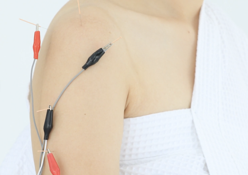 Electro-acupuncture treatment at Serenity Acupuncture & Wellness in Coeur d'Alene Idaho