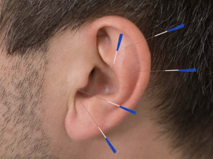Auricular acupuncture points used in Chinese medicine treatment in Coeur d'Alene Idaho