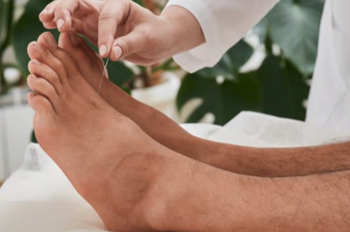 Acupuncture treatment for pain and nerve issues in Coeur d'Alene Idaho