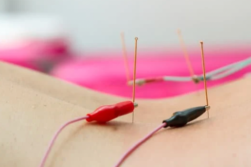 Electro-acupuncture treatment at Serenity Acupuncture & Wellness in Coeur d'Alene Idaho