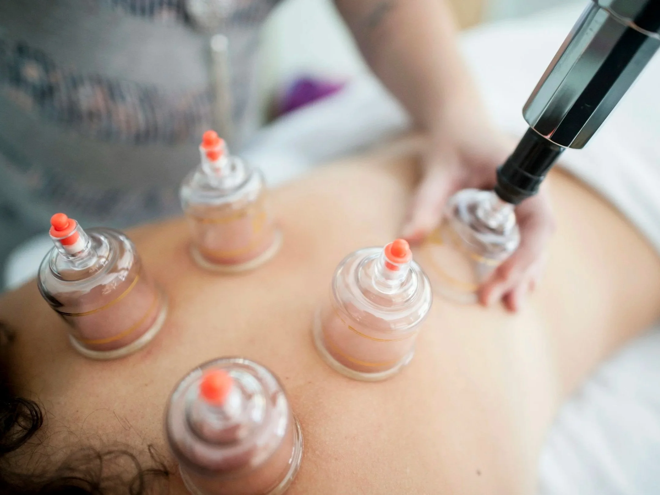Cupping therapy treatment at acupuncture clinic in Coeur d'Alene Idaho