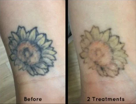 Voor en na resultaat van laser tatoeage verwijderen waarbij een bloemtatoeage zichtbaar vervaagt na twee behandelingen