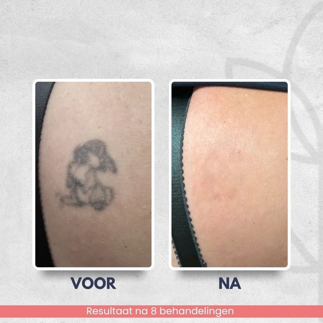 Resultaat van het verwijderen van een tatoeage op de schouder na 8 laserbehandelingen bij Laser Studio Lisa