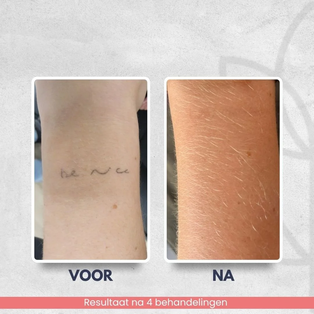 Resultaat na 4 laserbehandelingen tatoeage verwijdering op onderarm bij Laser Studio Lisa 