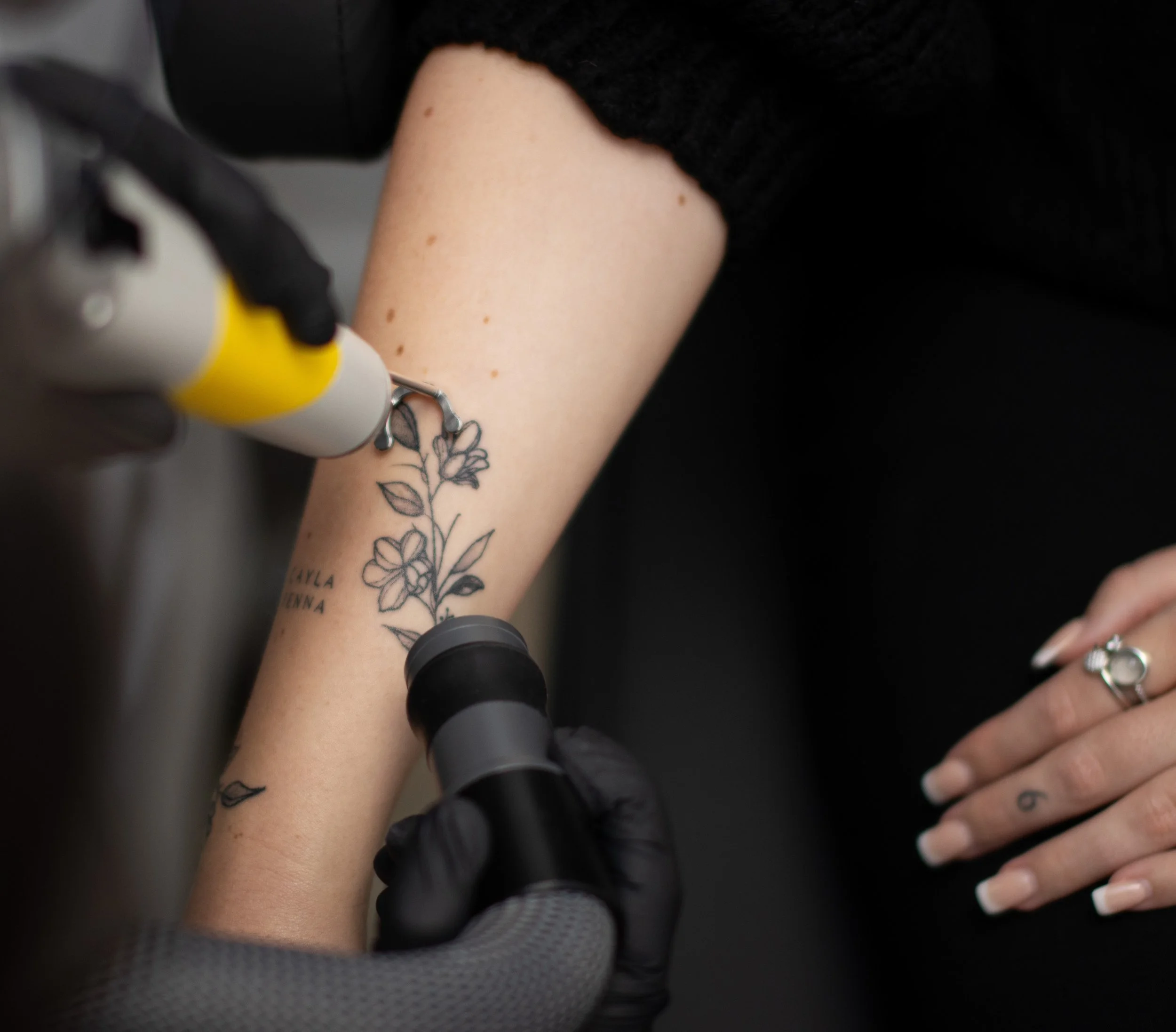 Close-up van laserbehandeling voor tatoeage verwijderen met professionele huidkoeling bij een klant