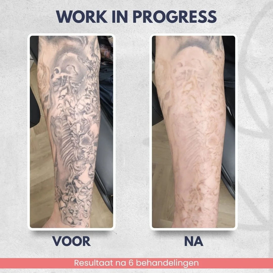 Work in progress tattoo verwijdering op onderarm bij Laser Studio Lisa in Fijnaart
