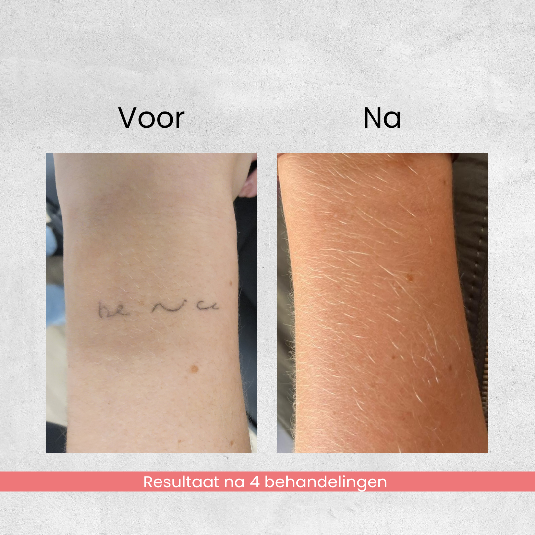 Voor en na resultaat van laser tatoeage verwijderen waarbij een kleine teksttatoeage vrijwel verdwenen is na vier behandelingen