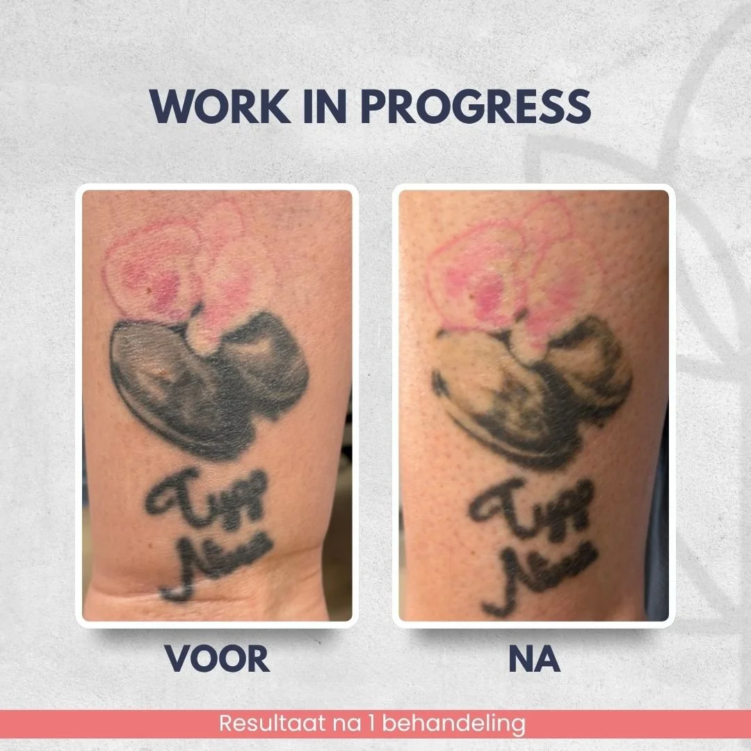 Resultaat na 1 laserbehandeling tatoeage onderbeen bij Laser Studio Lisa in Fijnaart