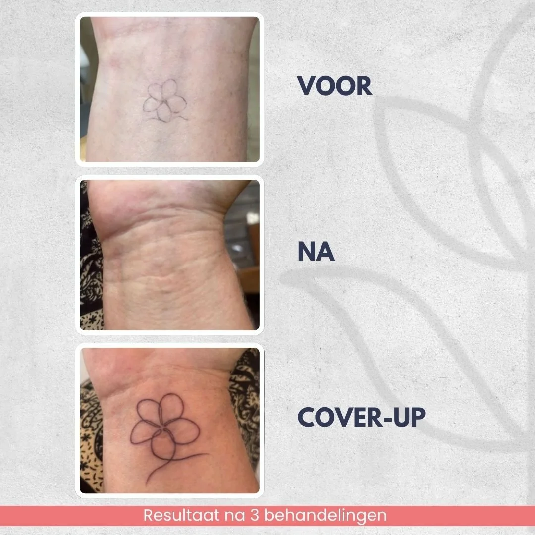 Resultaat na 3 laserbehandeling voor tatoeage verwijdering op de pols