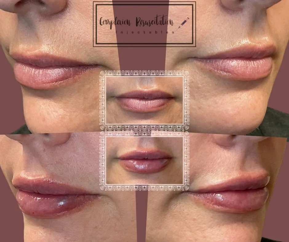 Close-up of a woman's lips before and after Lip Filler by Britni, showing improvement in lip volume and shape.